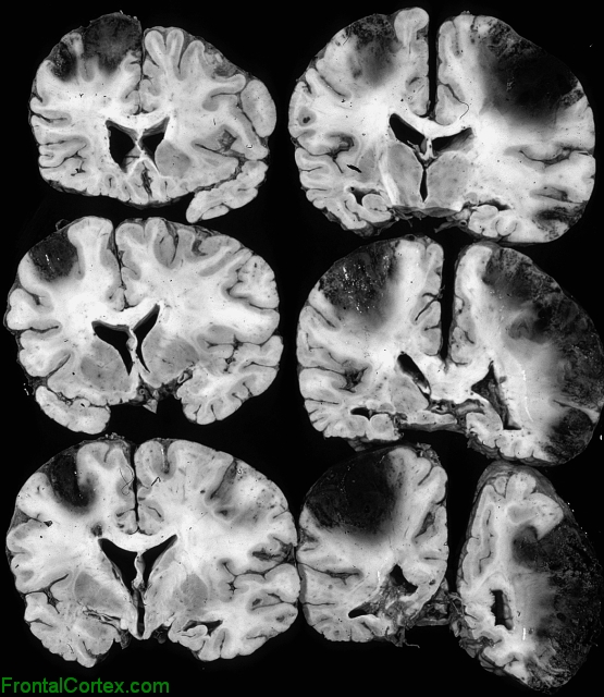 Cerebral venous infarcts, multiple coronal sections of brain